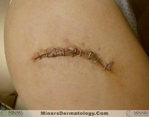 Skin Staples A