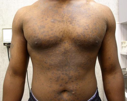 Tinea Versicolor002