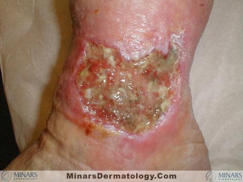 Venous Ulcer A
