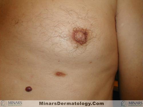 accessory nipple