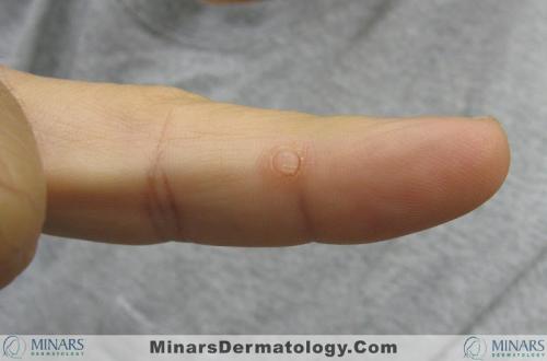 acquired digital fibrokeratoma