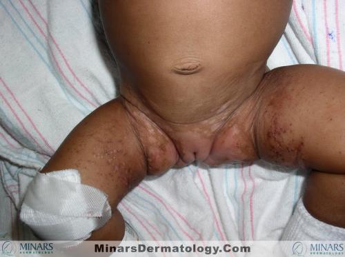 acrodermatitis enteropathica002