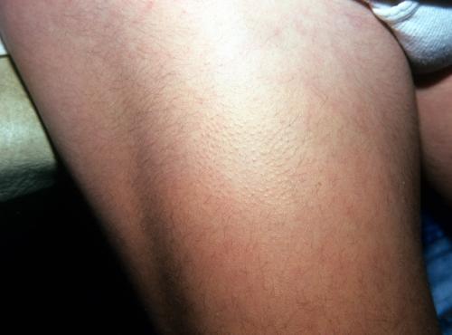alopecia mucinosa 2 (4)