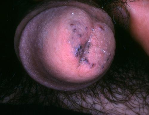 angiokeratoma (4)