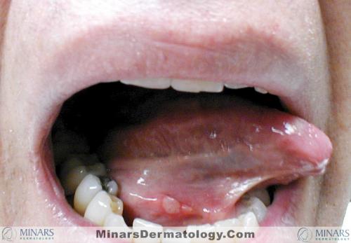 apthous ulcer A