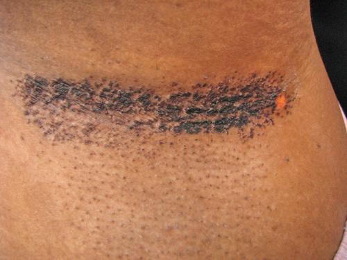 axillary granular parakeratosis
