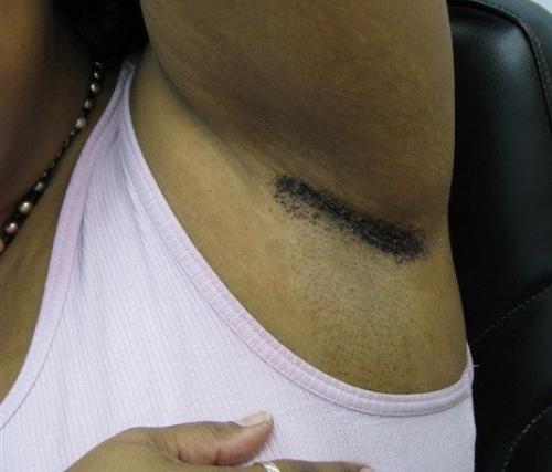 axillary granular parakeratosis 2
