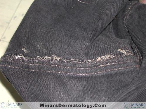 body lice seam