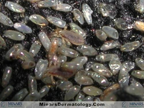 body lice seam close