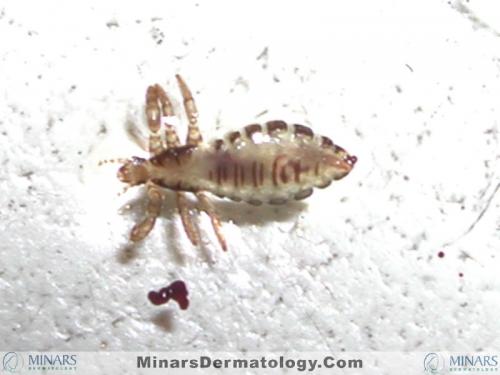 body louse