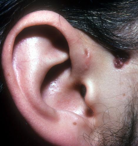 brancial cleft cyst