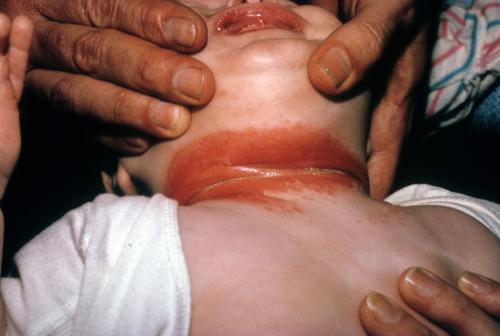 candida intertrigo