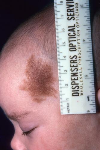 congenital nevus.jpg
