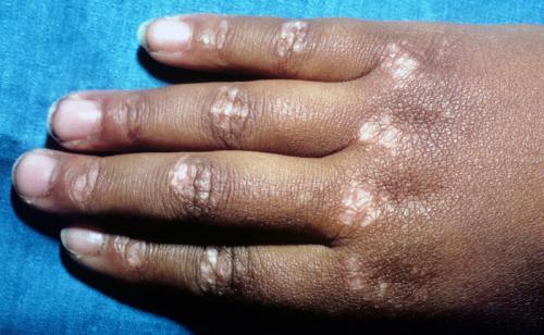 dermatomyositis (2)