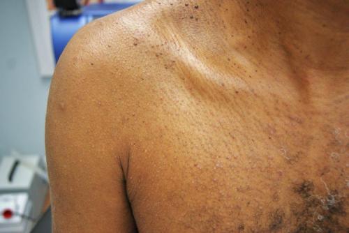 disseminate and recurrent infundibulofolliculitis 3