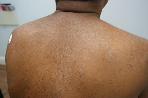 disseminate and recurrent infundibulofolliculitis 6