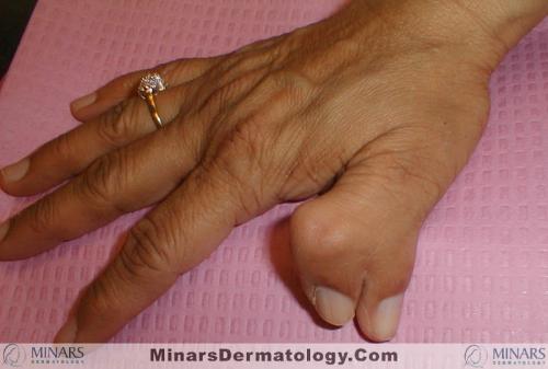 double thumb A