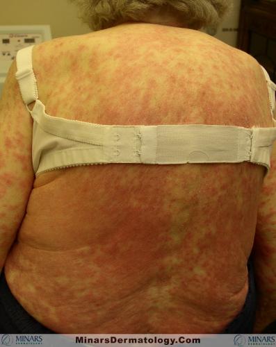 drug rash 0002