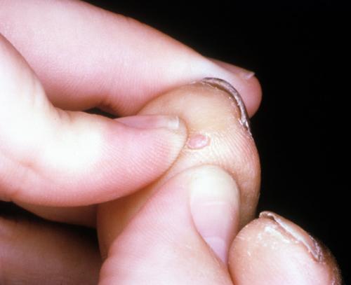 eccrine poroma (2)