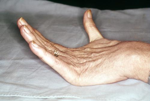 ehlers danlos.jpg