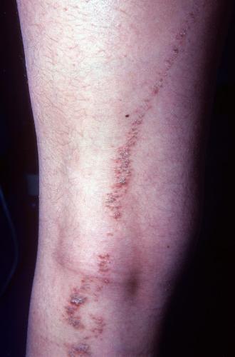 epidermal nevus (2)
