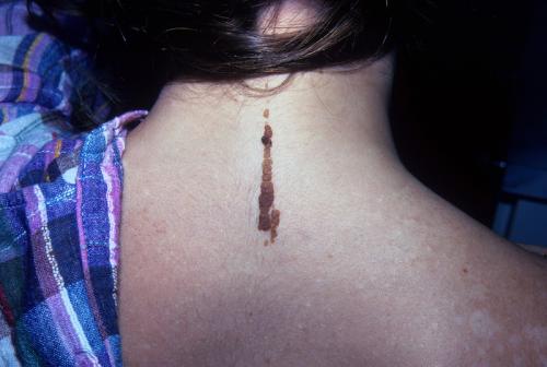 epidermal nevus (3)
