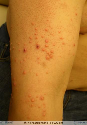 eruptive xanthoma A
