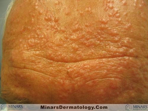 follicular mucinosis (6)