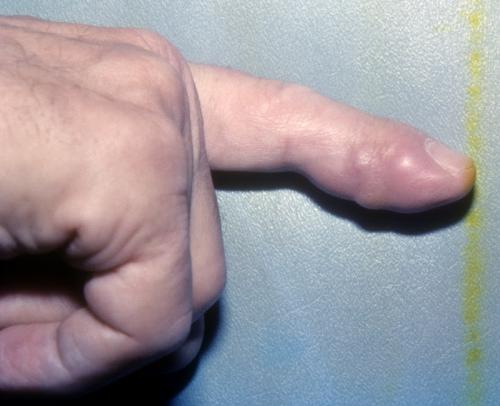 giant cell tumor (3)