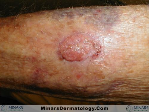 granulation tissue A