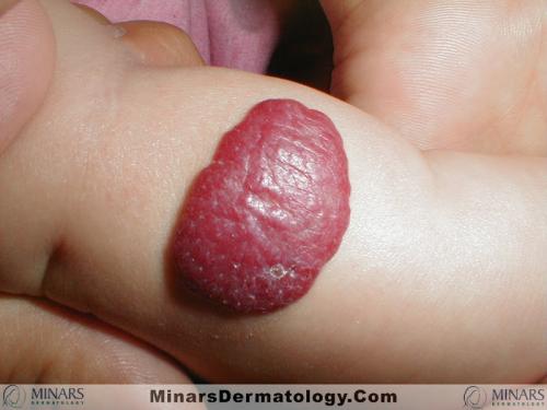 hemangioma 01 A