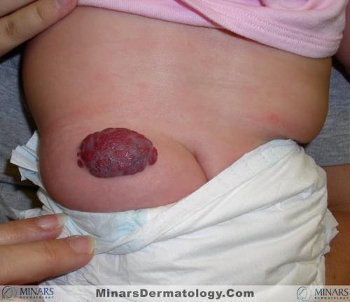 hemangioma 02 A