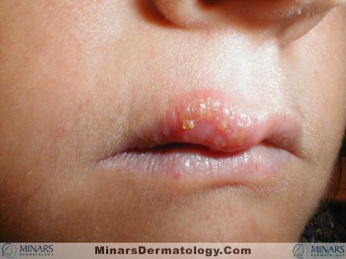 herpes simplex 016
