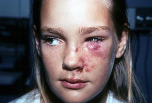 herpes zoster3
