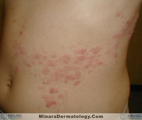 herpes zoster A