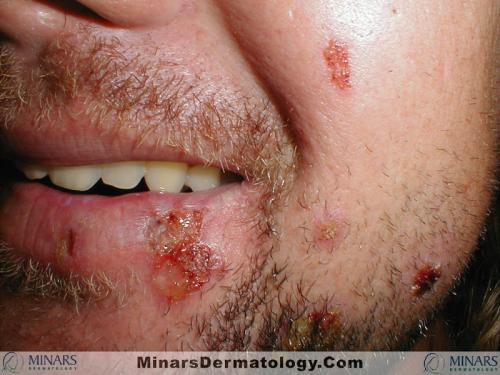 impetigo 01 A