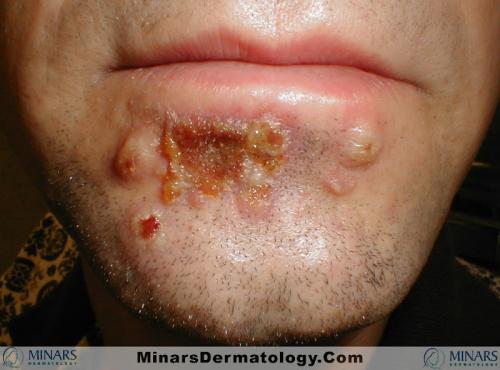 impetigo 02 A