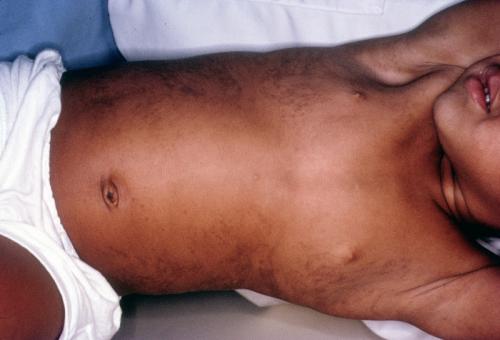 incontinentia pigmenti
