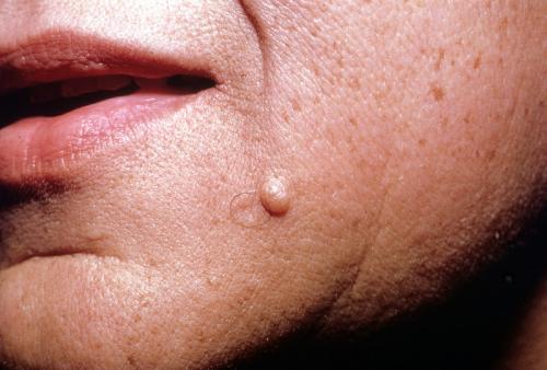 intradermal nevus.jpg