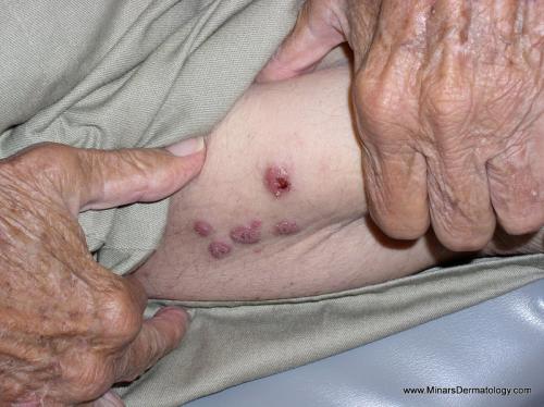 lymphoma
