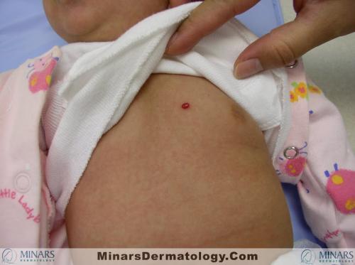 neonatal hemangiomatosis 3