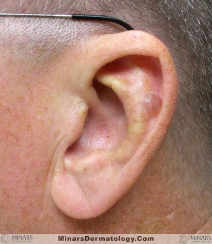 pseudocyst of auricle