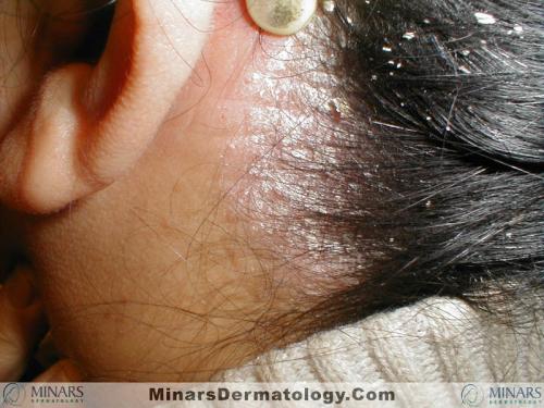 psoriasis 01 A