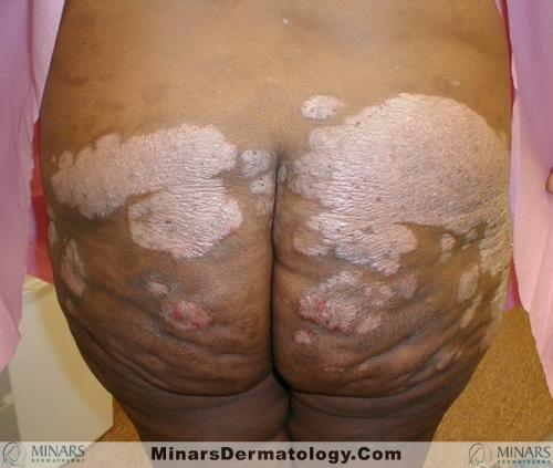 psoriasis 06 A