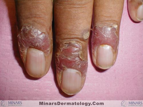 psoriasis 08 A