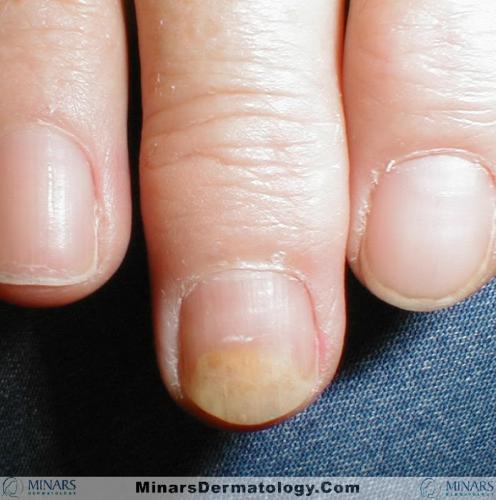 psoriatic nails 01 A