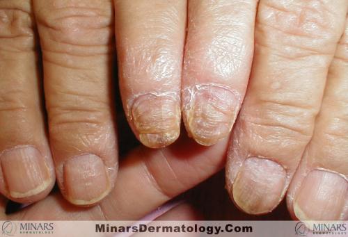 psoriatic nails 03 A
