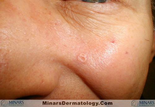 sebaceous hyperplasia A