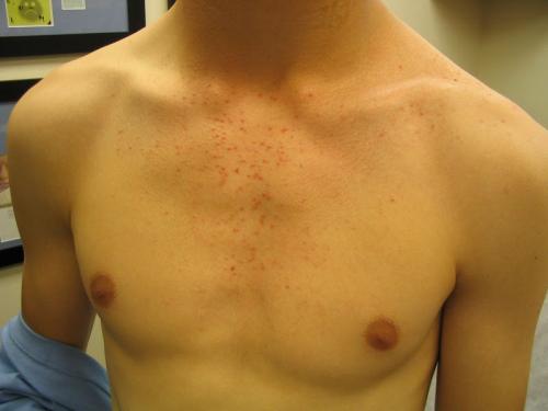 steroid acne crohns (2)