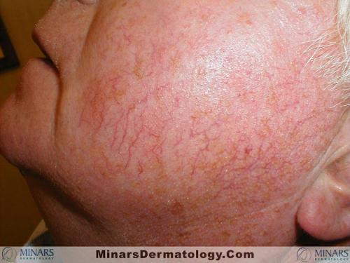 telangiectasia A